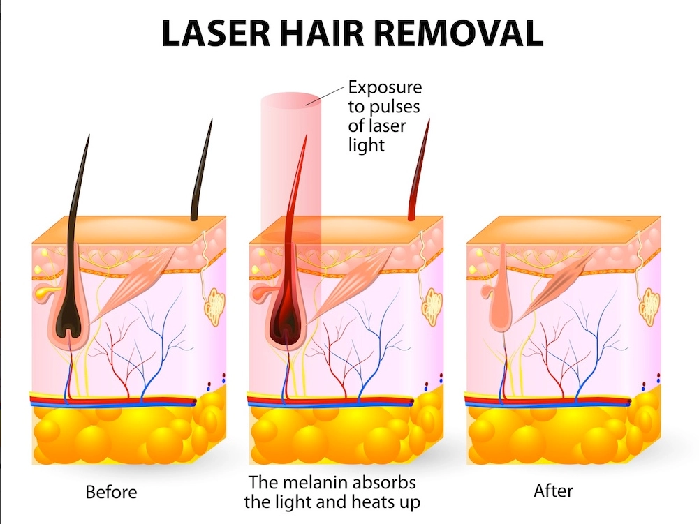 laser hair removal principle