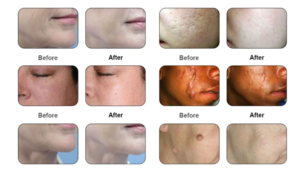 Laser treatments- before and after
