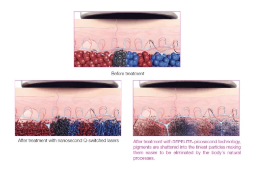 Real Picosecond Laser Pigment Tattoo Removal Laser Machine works-optimal healing