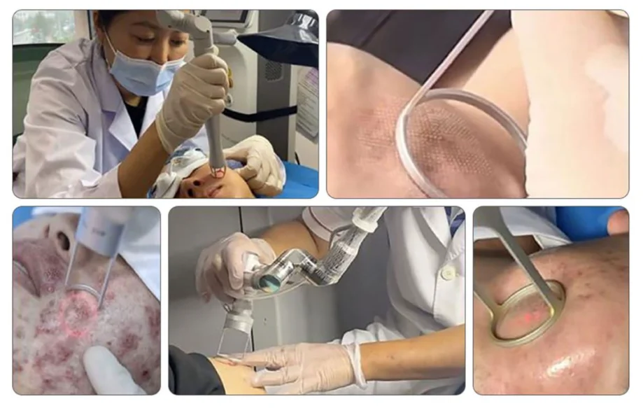 System features adjustable settings, allow clinicians to tailor treatment for different skin types and concerns.