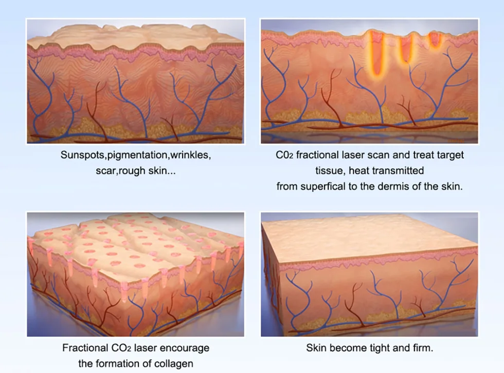 how laser works to skin-Laser treatments work by delivering controlled light energy into the skin