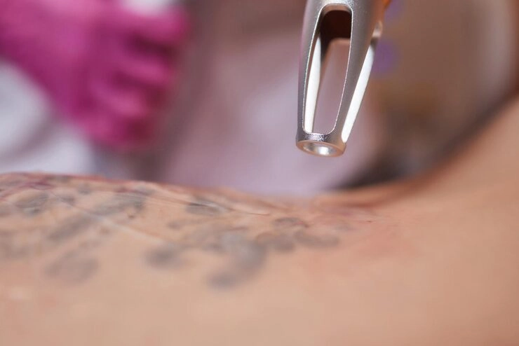 1young-woman-undergoing-laser-tattoo-removal-procedure-salon-closeup1