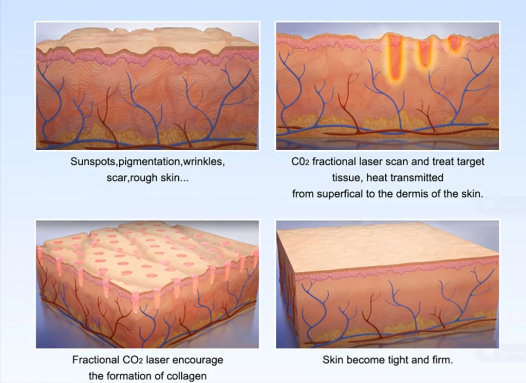 DEPPLUS®-Stationary-Fractional-Co2-Laser-Scar-Wrinkle-Removal-Machine-MQLASER-08-01-2025_06_52_PM