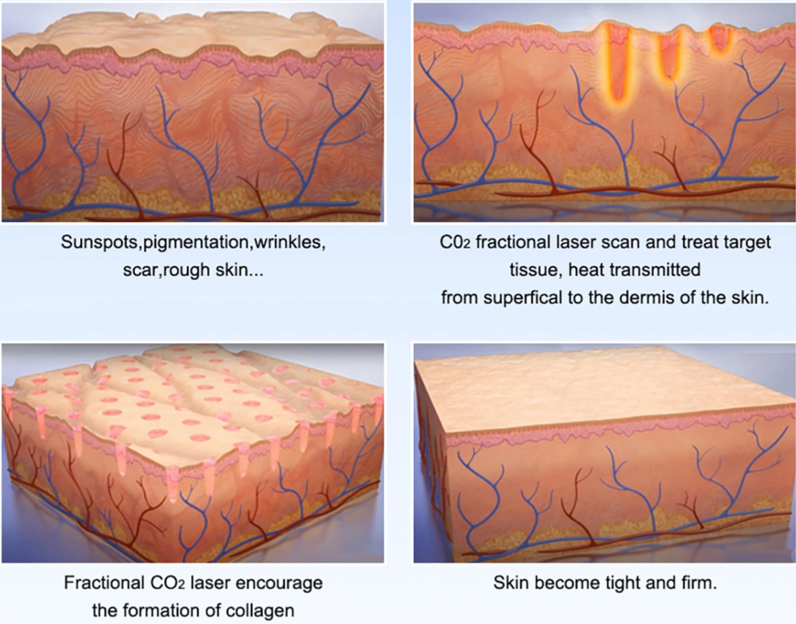Fractional-Co2-Laser-Scar-Wrinkle-Removal
