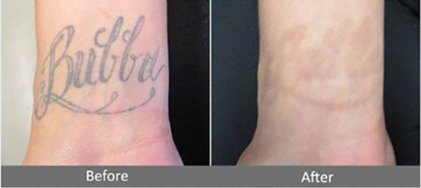 Tattoo-Removal-Laser-Machine-MQLASER