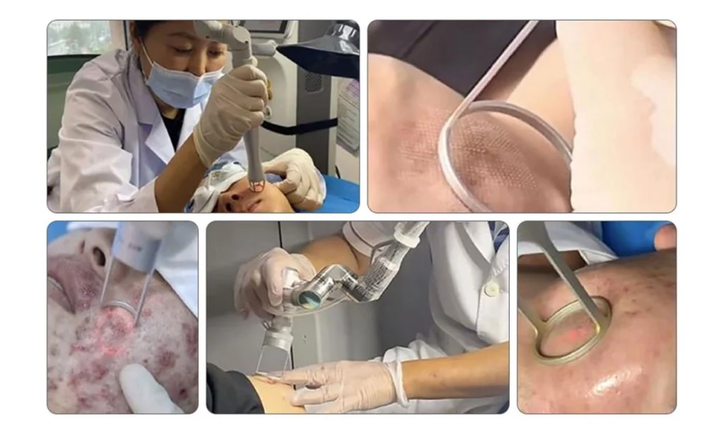 CO2-LASER-SKIN