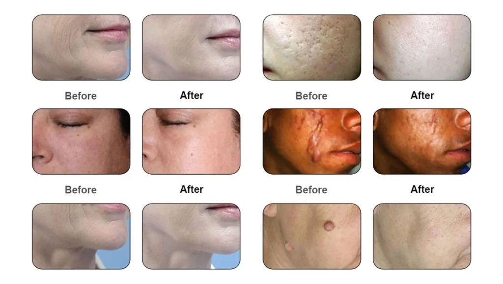 CO2-LASER-SKIN-16-1