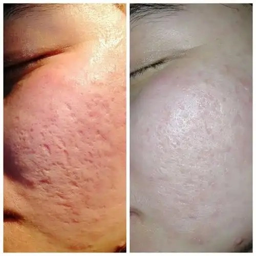 CO2 Laser Treatment for Acne Scars