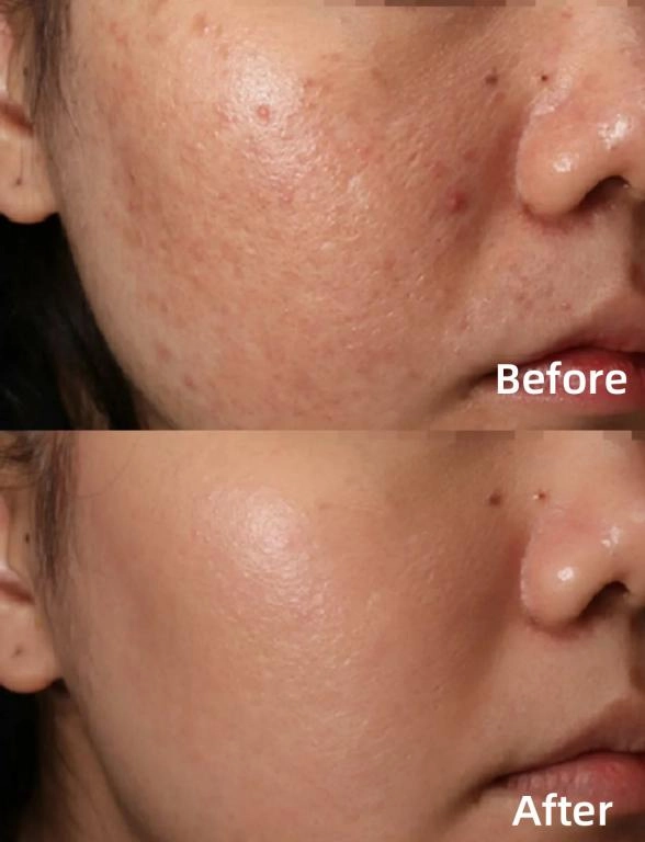 Improving the Appearance of Acne Scars