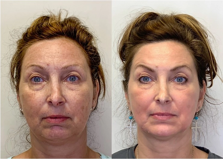 a woman before and after treatment