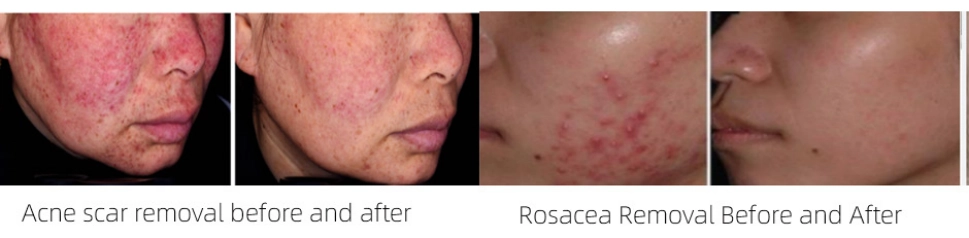 acne removal before and after