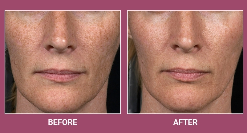 before and after the co2 laser treatment