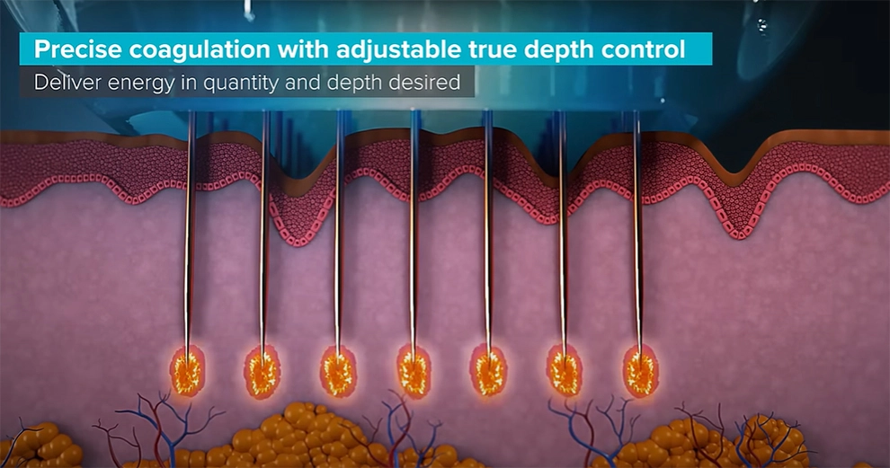 benefits of microneedling for scar improvement