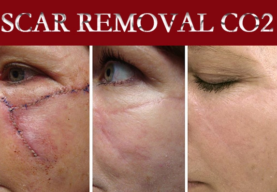 scar disappears from a woman’s face