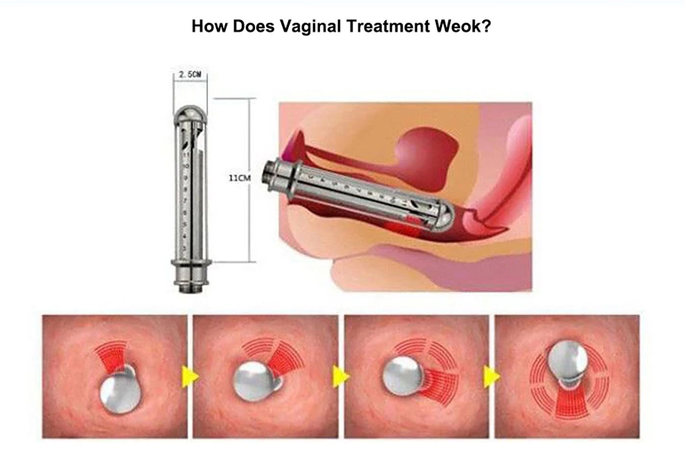 HIFU Vaginal Treatment Vs CO2 Laser Vs RF A Comparative Guide For 