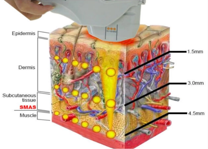 How HIFU Works to Stimulate Deep Skin Tightening