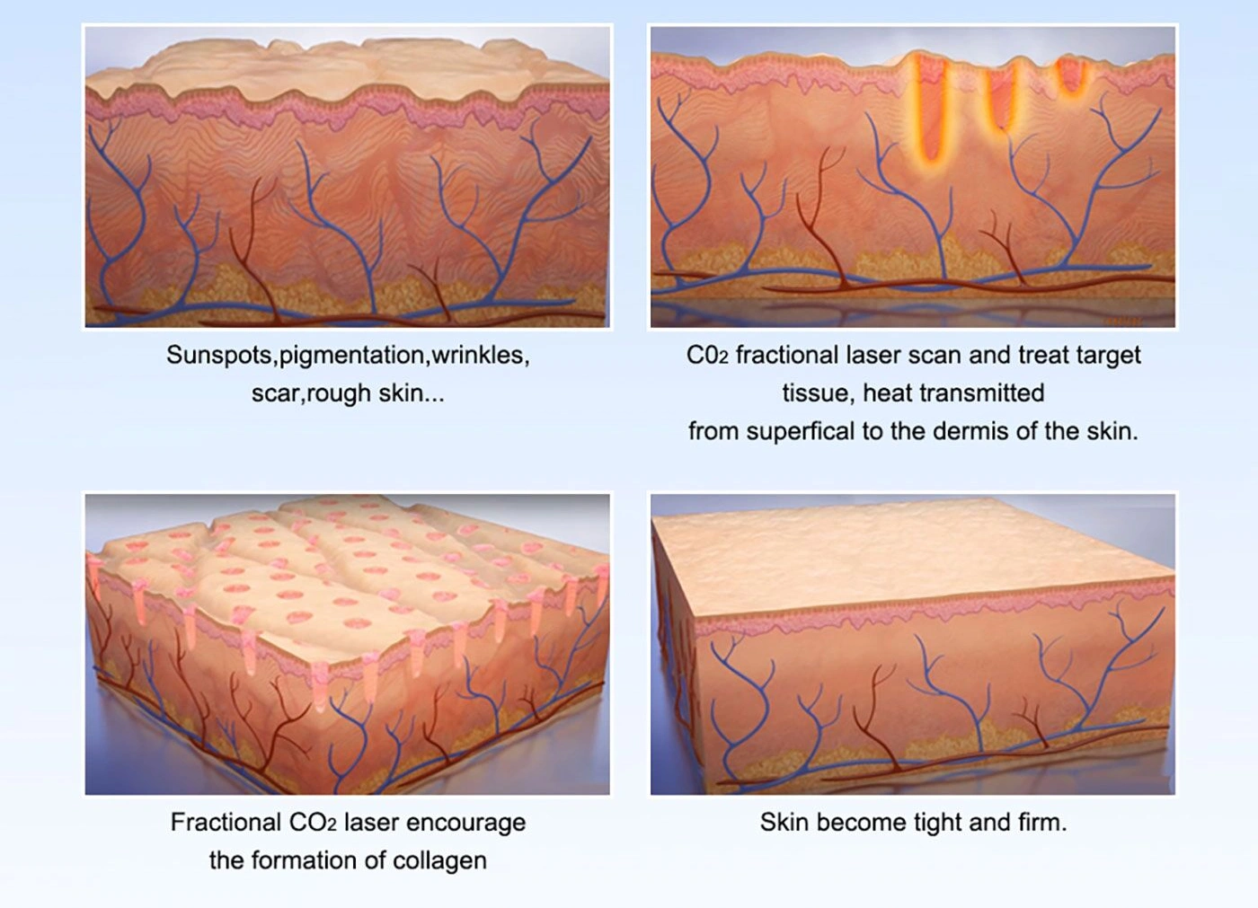 Mechanism Behind Fractional CO2 Laser Technology