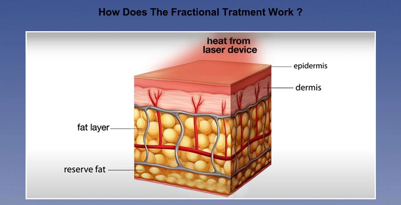 Overview of CO2 Laser Resurfacing Technology