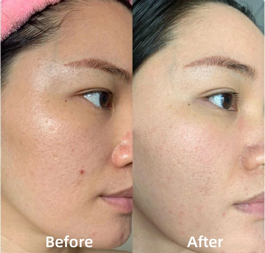 advantages of CO2 laser treatment in beauty practices