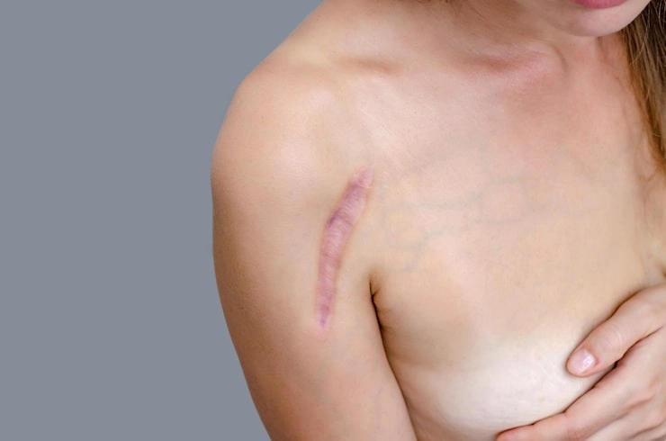 woman with scar on her shoulder