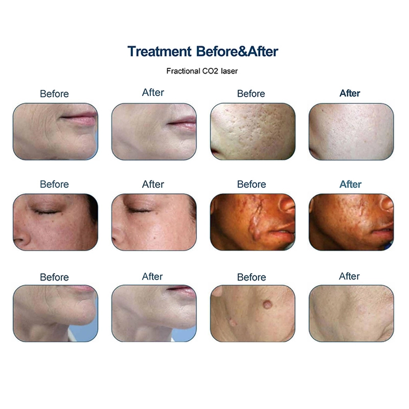 Before & After CO2 Laser Treatment
