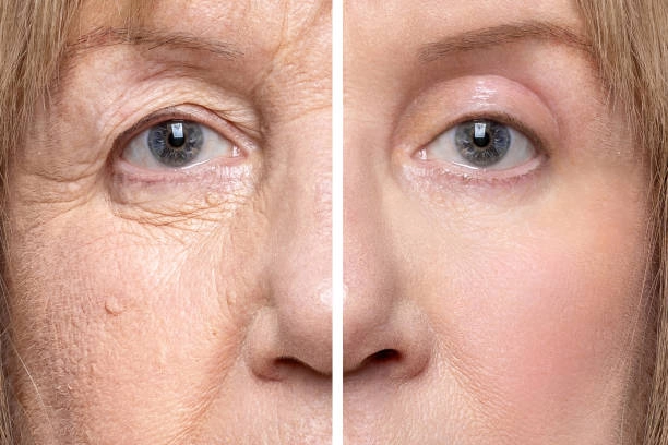 Contrast before and after wrinkle treatment