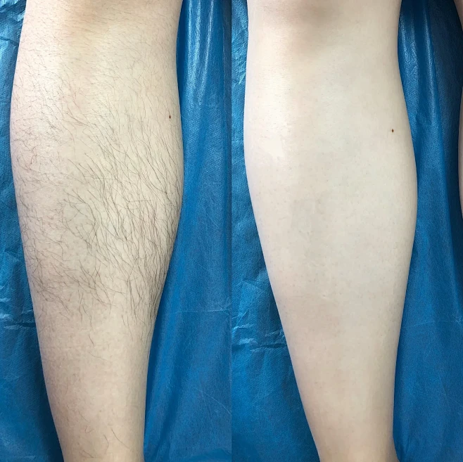Pre-and post-contrast analysis of hair removal