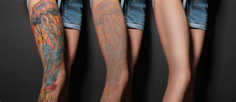 tattoo remove