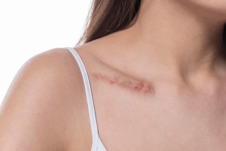 1 woman-showing-surgery-scar-scars-removal-concept-close-up-selective_706756-3478