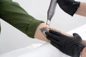 How Picosecond Lasers Remove Ink and Imperfections with Little to No Downtime