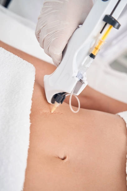 Comprehensive Comparison Candela CO₂ RE vs. MQLASER DEPPLUS CO₂ Laser