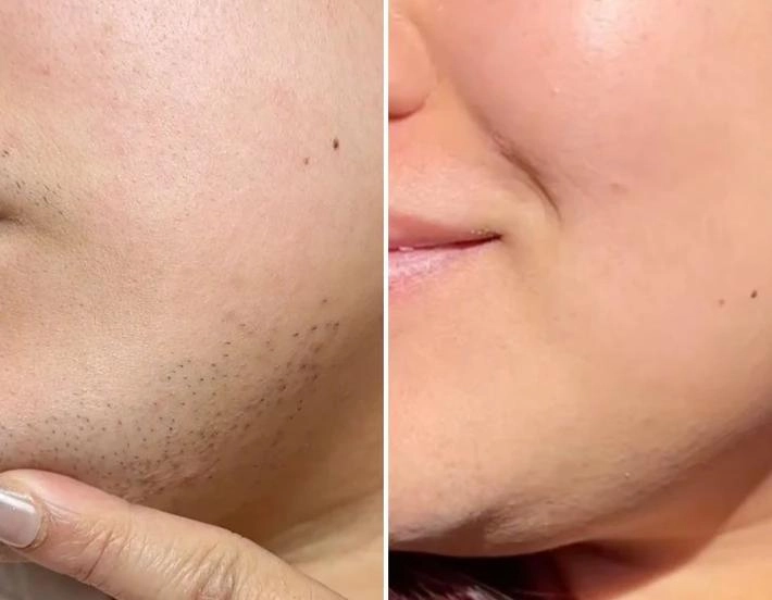 Pre-and post-comparison of the face