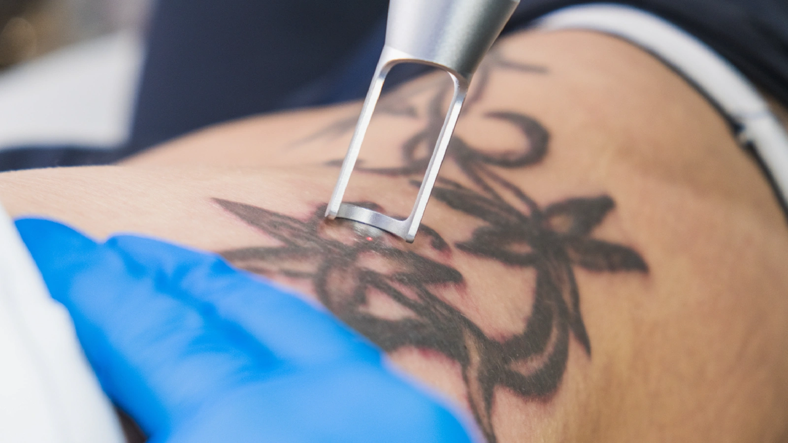 Tattoo removal
