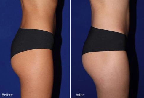 before and after body comparison