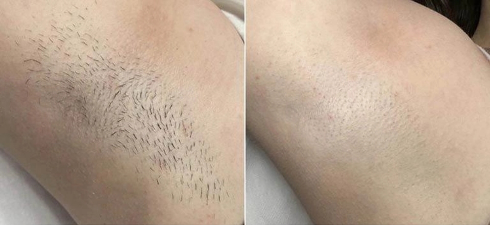 before and after comparison of a armpit