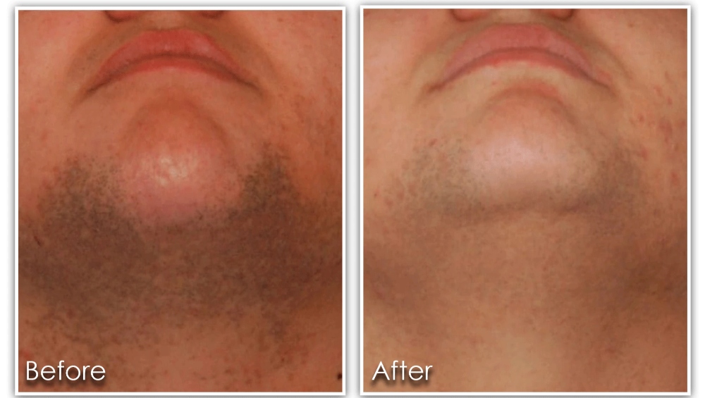 before and after comparison of a man's face
