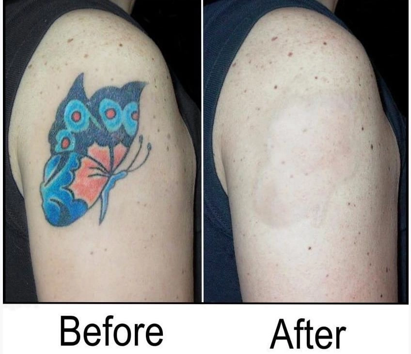 changes in arm color tattoos