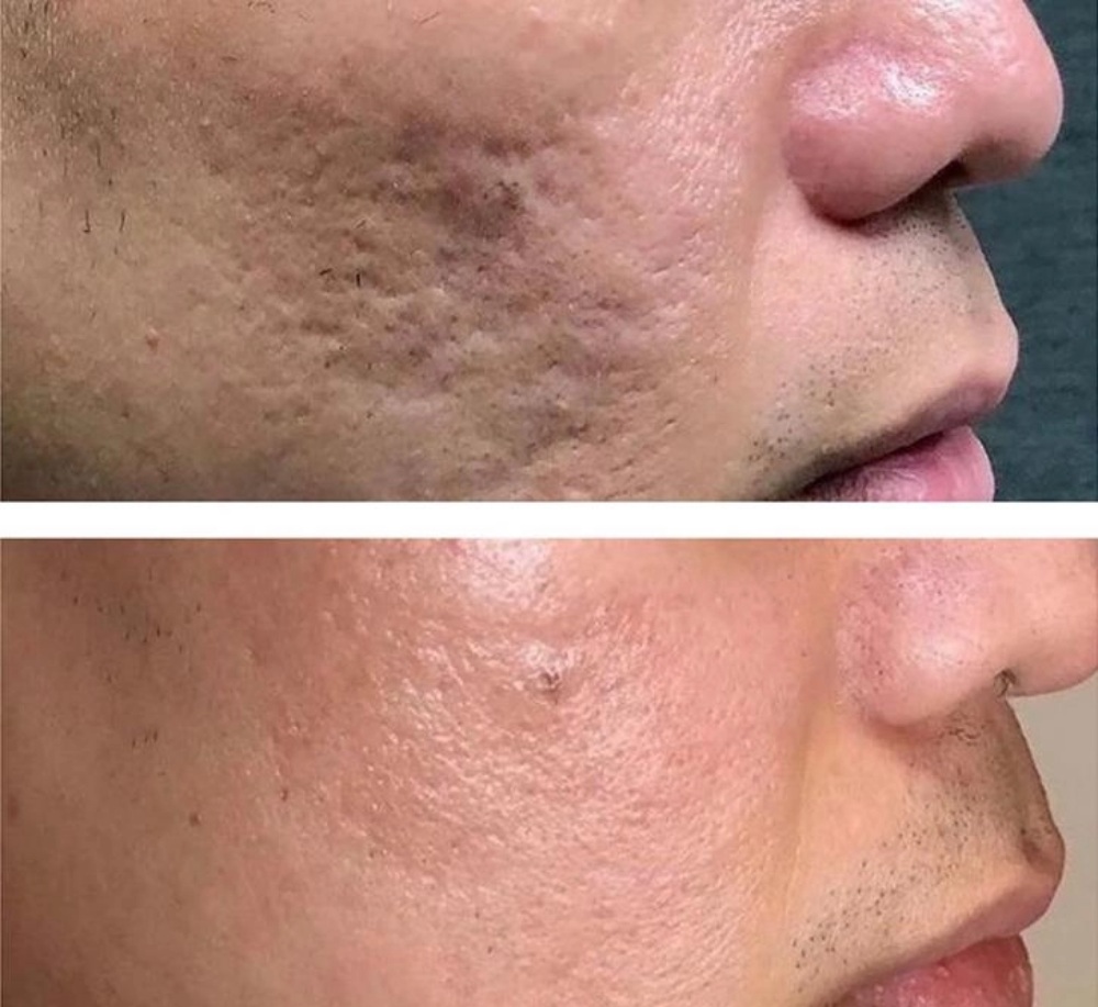 before and after comparison of a man's face