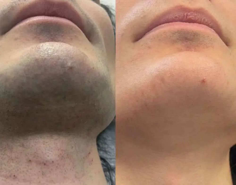 before and after comparison of a man's face