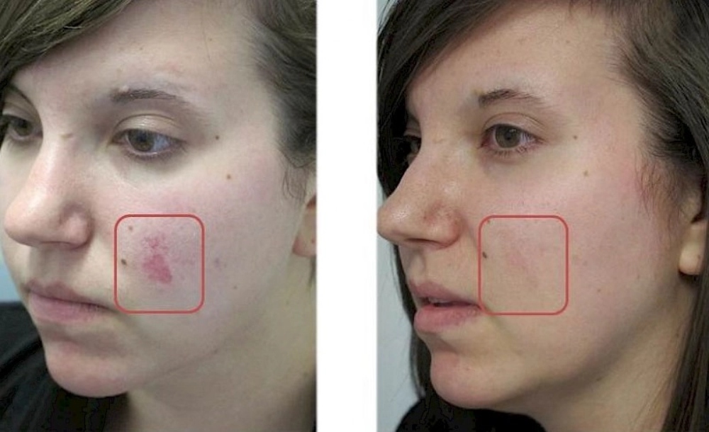 before and after comparison of a woman's face