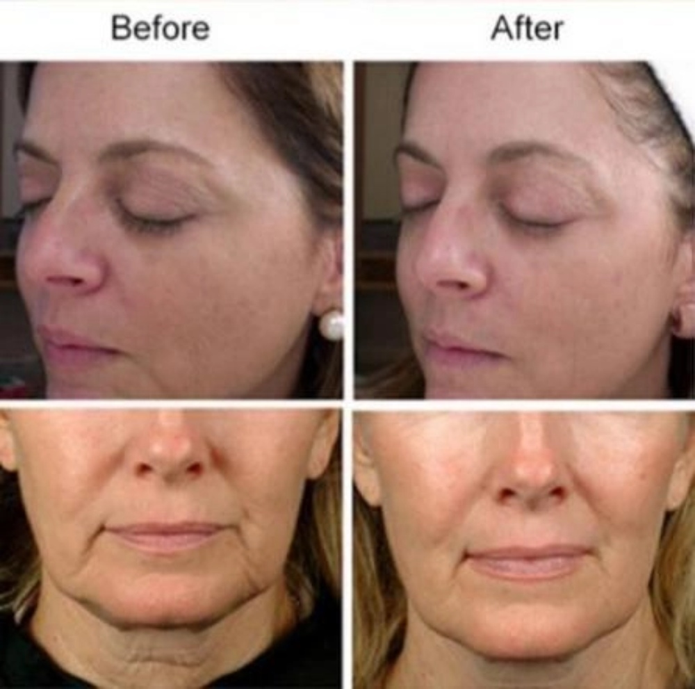 before and after comparison of women's face