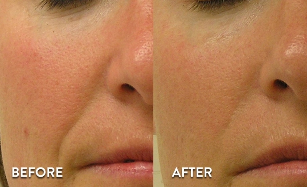 before and after treatment