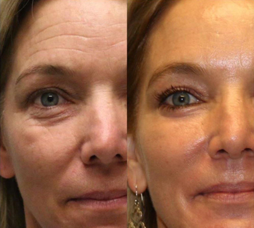 changes in a woman's face before and after