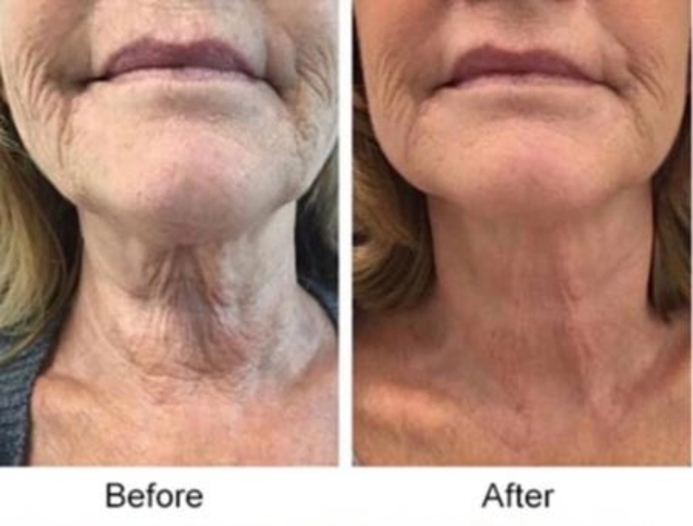 comparison of a woman's neck before and after