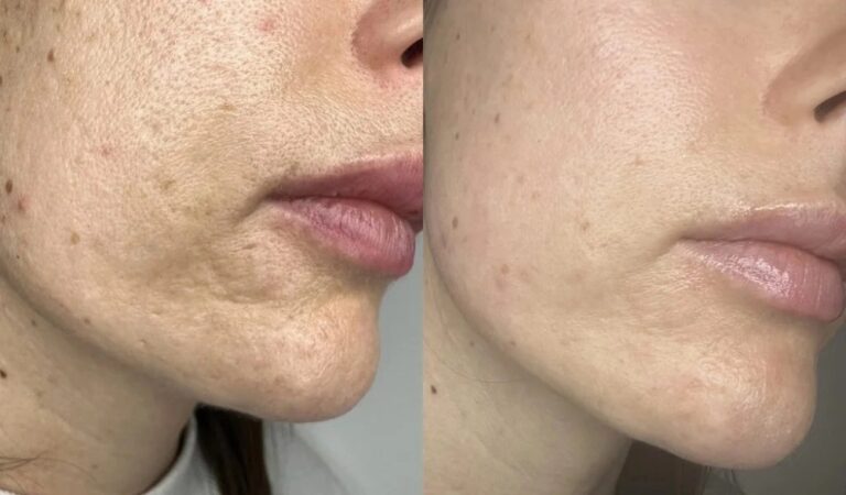Candela CO2 RE vs MQLASER DEPPLUS Upgrading Your Aesthetic Business