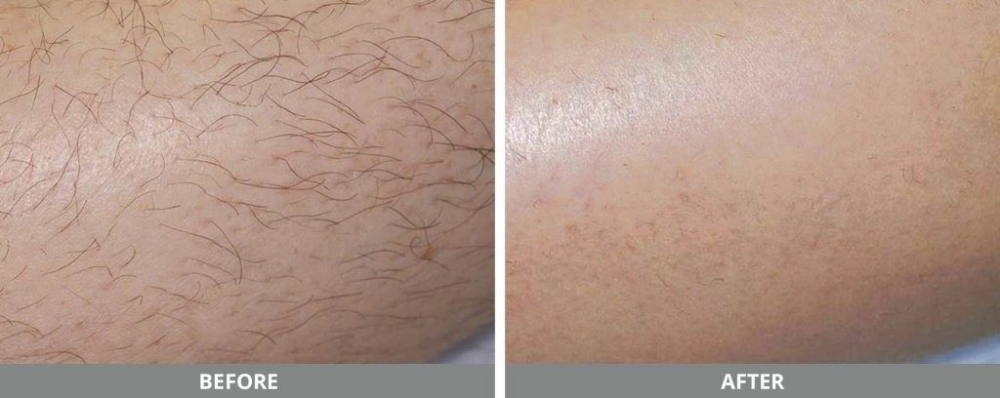 arm before and after comparison