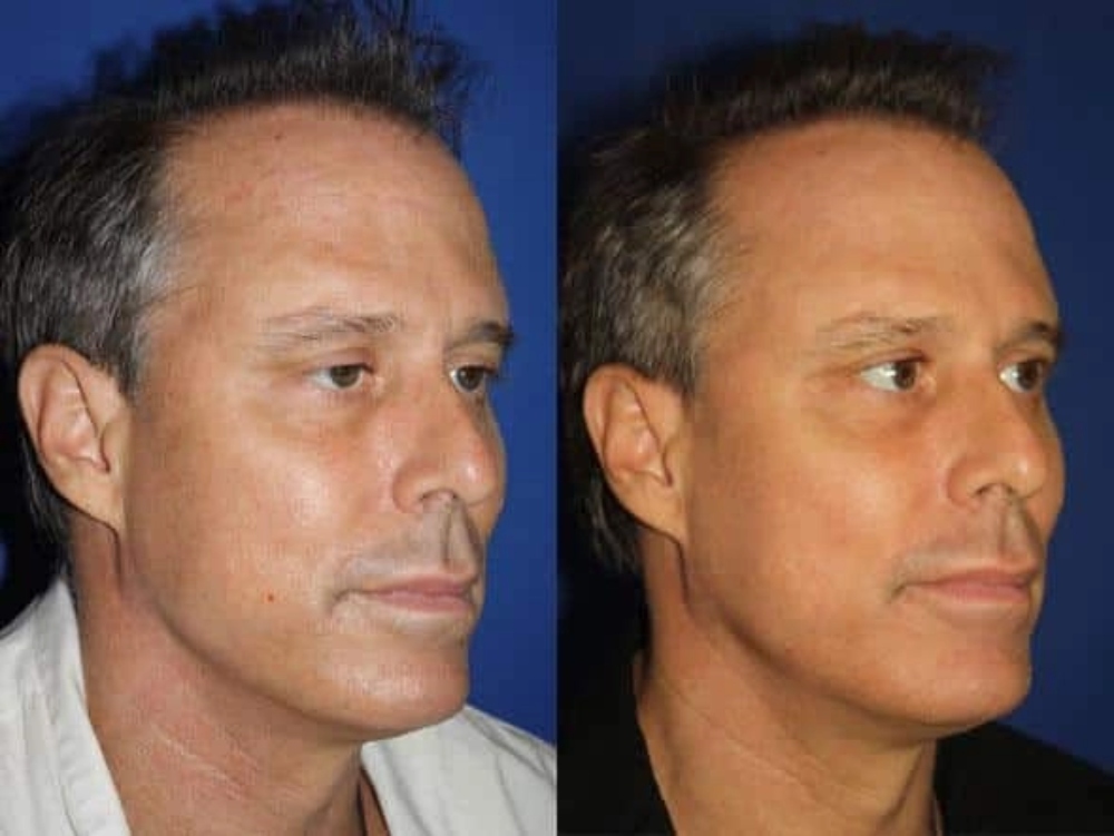 before and after comparison of a man's face