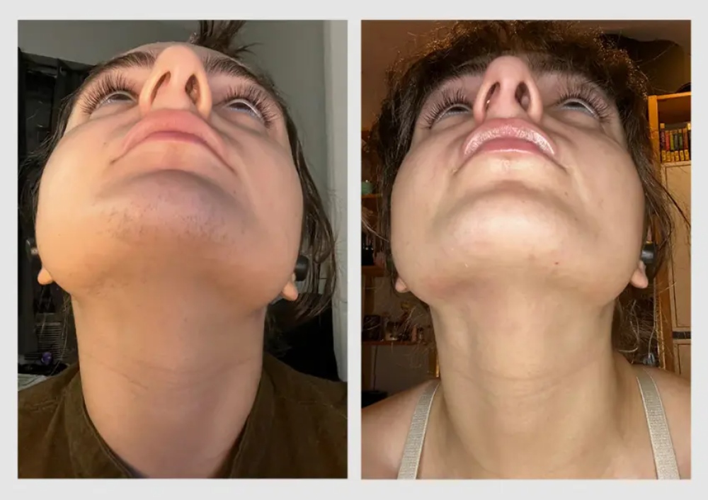 before and after comparison of a woman's chin