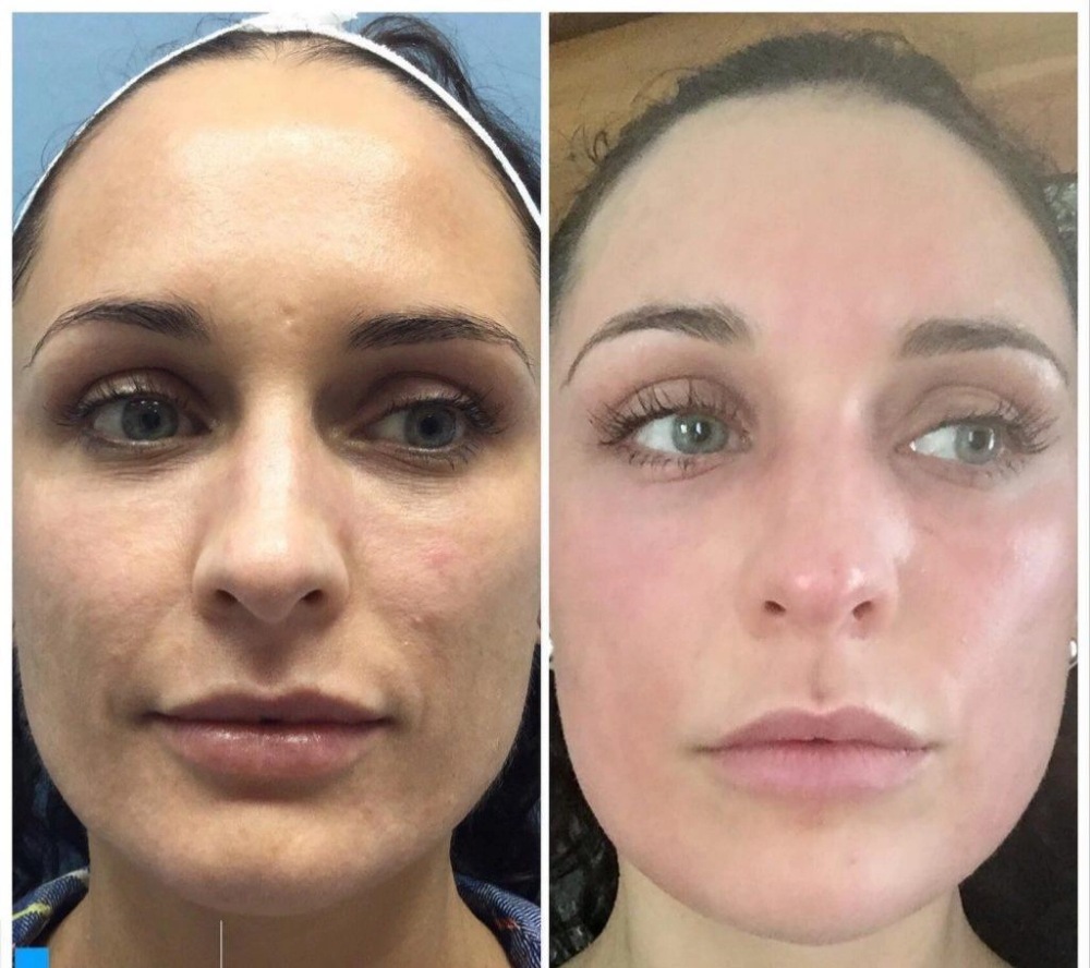before and after comparison of a woman's face