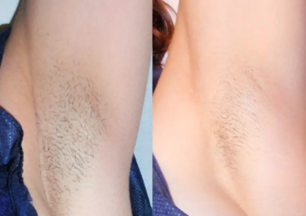 before and after comparison of armpits